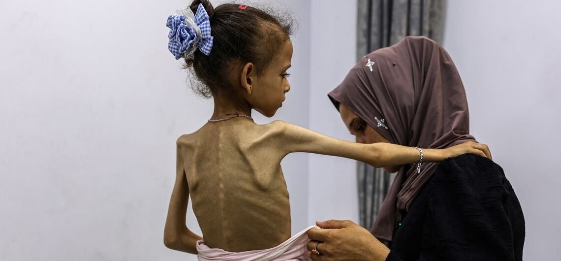 Seorang anak perempuan di Gaza yang mengalami malnutrisi akut. (WHO)
