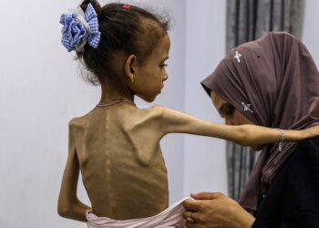 Seorang anak perempuan di Gaza yang mengalami malnutrisi akut. (WHO)
