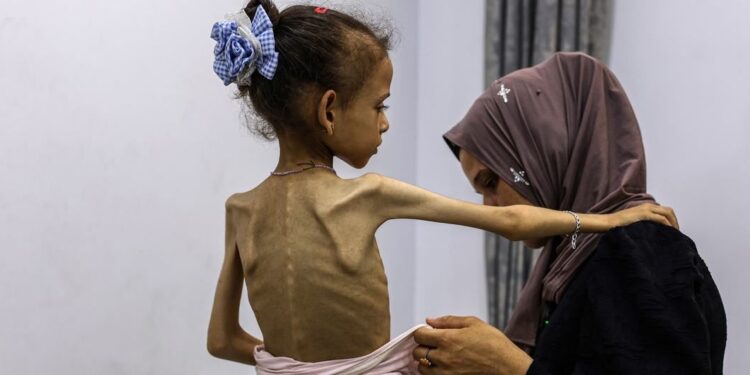 Seorang anak perempuan di Gaza yang mengalami malnutrisi akut. (WHO)